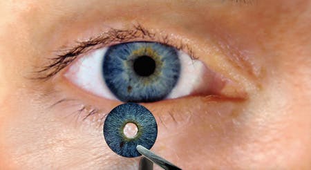 HumanOptics' CustomFlex Artificial Iris Approved as Breakthrough